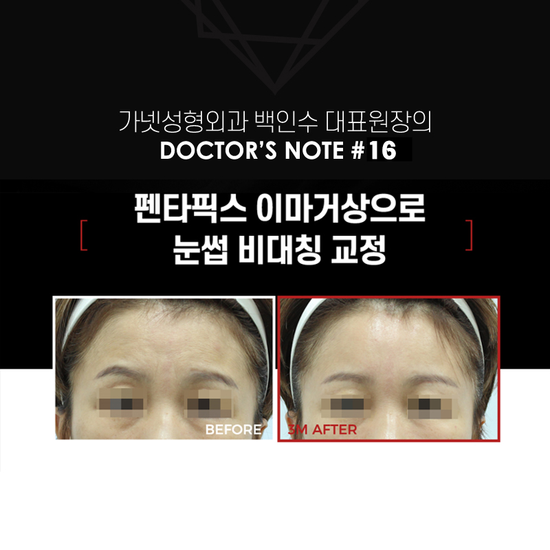 【가넷성형외과 백인수원장 성형칼럼】 펜타픽스이마거상으로 눈썹 비대칭 교정 관련 이미지 2