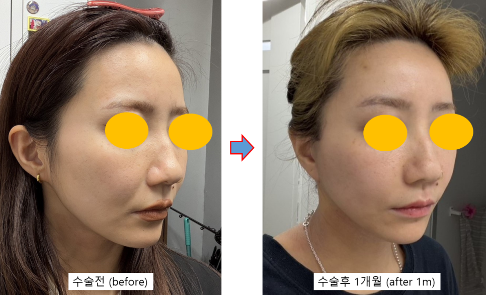 A Deep Mini Facelift Case for a Japanese Patient Who Was Disappointed with the Longevity of Thread Lifting image 5