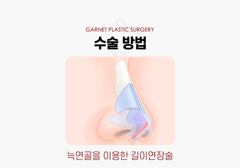 【Garnet Plastic Surgery Director Baek Insoo’s Plastic Surgery Column】 Rib Cartilage Contracted Nose Revision Surgery (Removal of Nose Implant) image 5