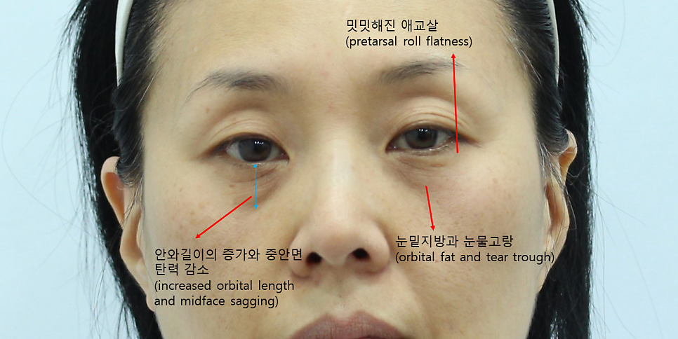 Lower Blepharoplasty in Your 50s to Add Firmness to the Midface image 1