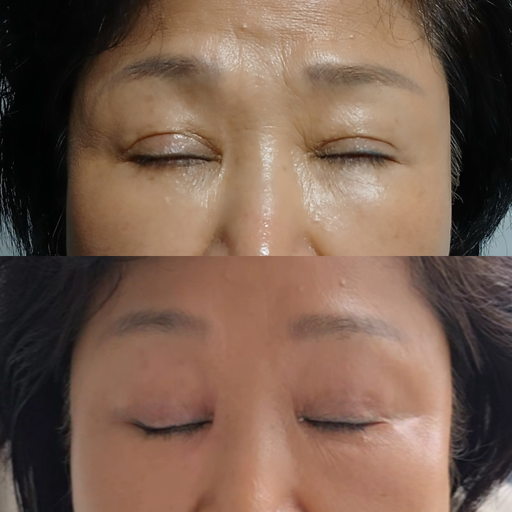 쌍꺼풀 재수술, 함몰흉터는 개선되고 눈은 편해졌습니다 - 6개월 흉터 성숙 과정 관련 이미지 7