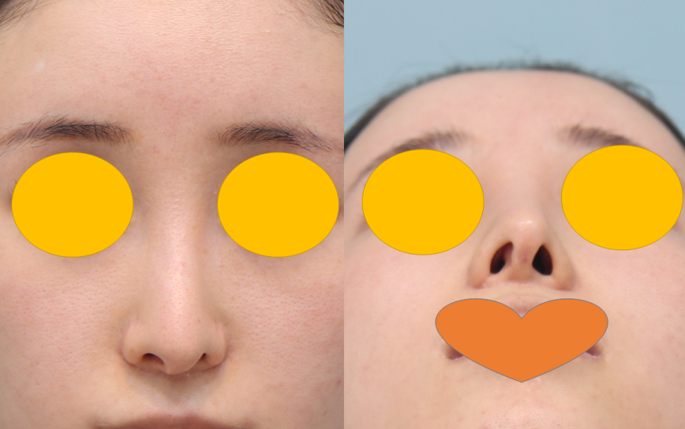 Consultation Process and Surgical Items for Revision Rhinoplasty image 1