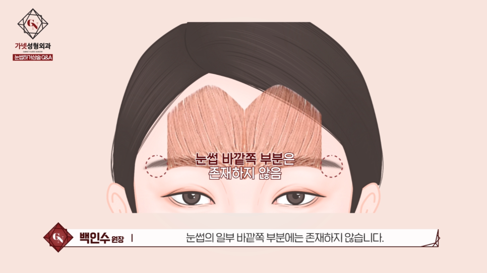 Differences Between Upper Eyelid Lift and Upper Blepharoplasty, and Brow Lift Scars: Explained by a Board-Certified Plastic Surgeon image 3