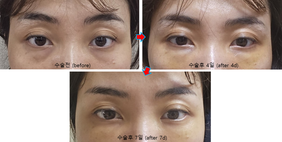 여름휴가 성형, 직장인에게 인기 있는 눈밑지방재배치(Hamra법) 관련 이미지 4