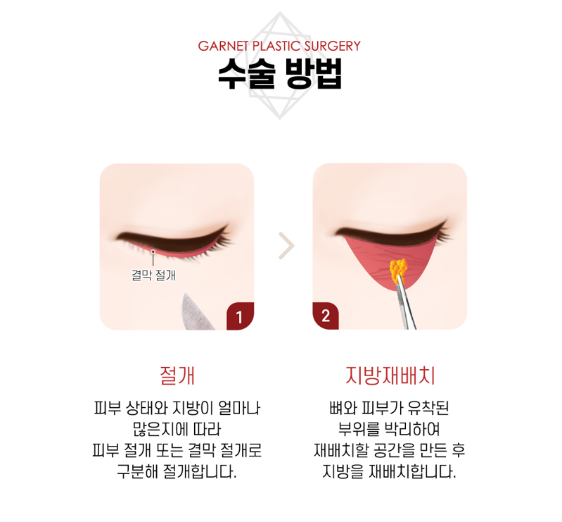 【Garnet Plastic Surgery Director Baek In-su’s Plastic Surgery Column】 Erasing Dark Circles with Under-Eye Fat Repositioning image 4