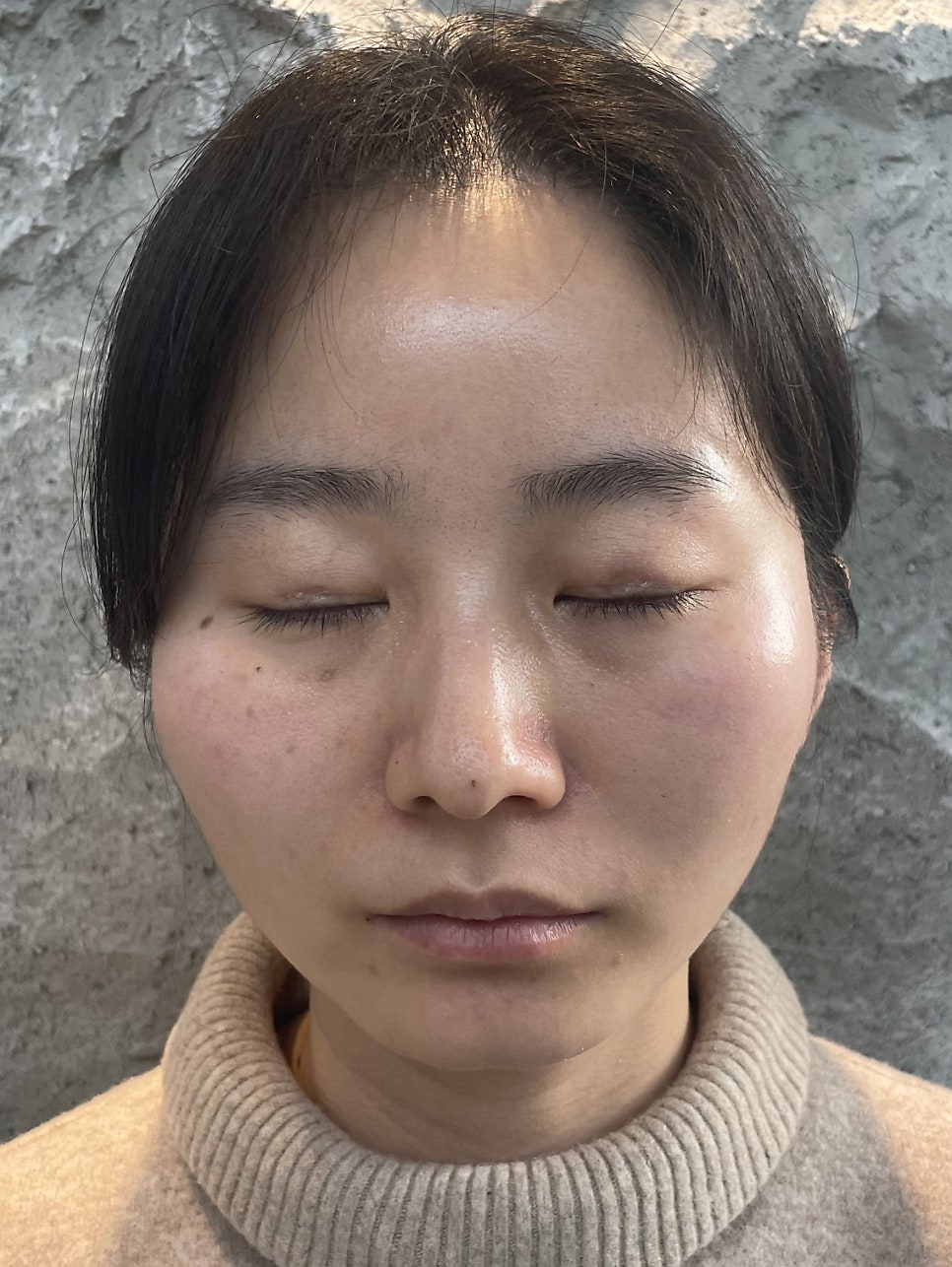 쌍꺼풀 함몰흉터를 교정하는 재수술 관련 이미지 1