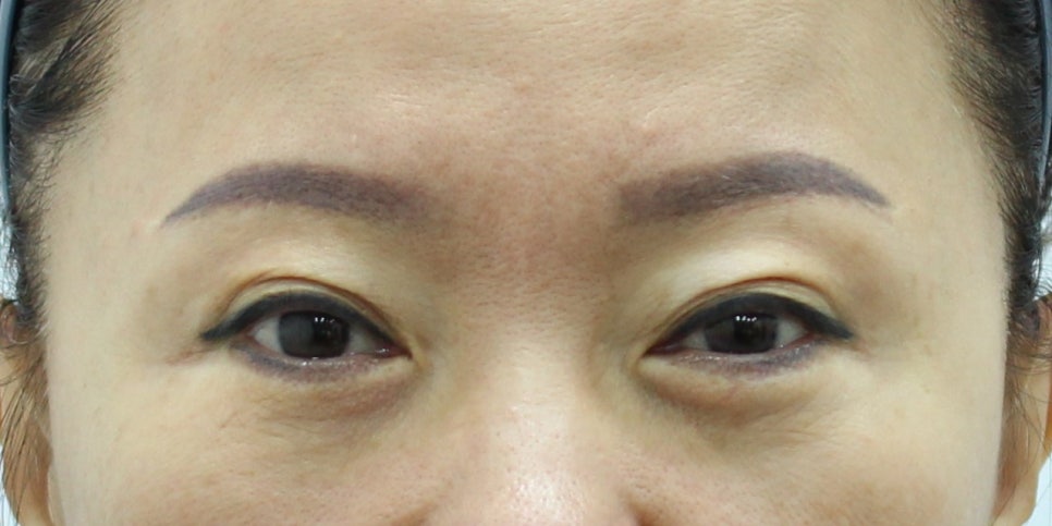쌍꺼풀 재수술 흉터, 피부결을 따라야 자연스럽습니다 관련 이미지 1