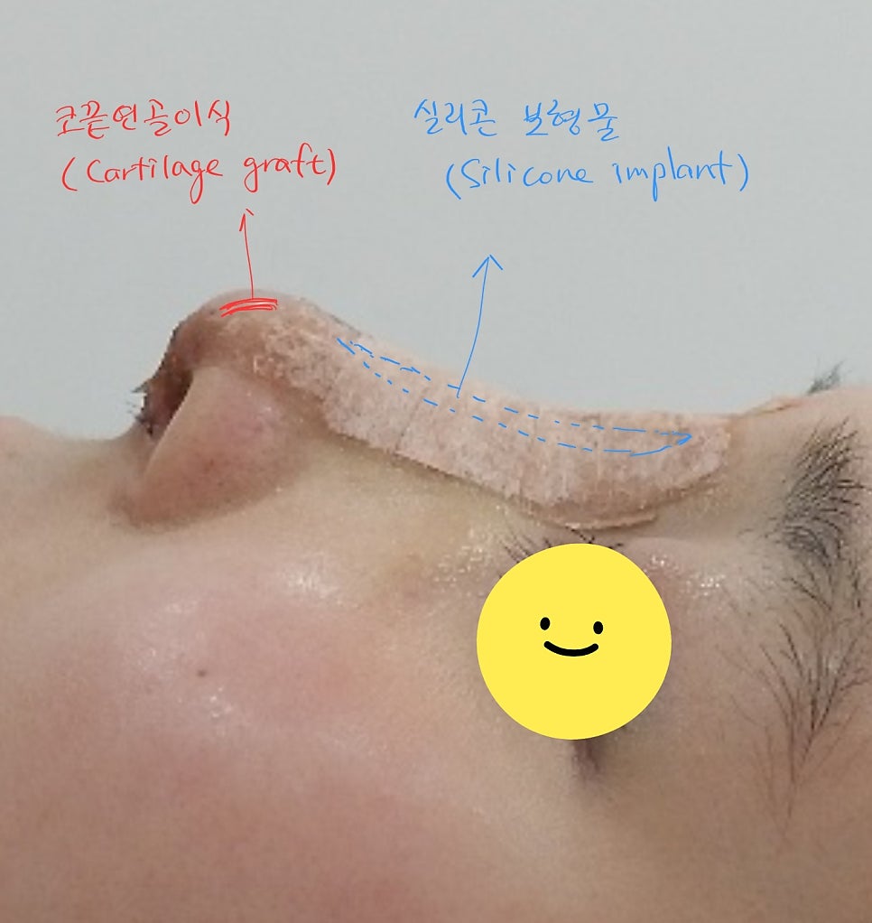 Treatment Process to Speed Recovery After Rhinoplasty image 6