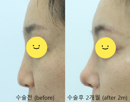 실과 필러로 높힌 코에서 발생한 염증의 치료 관련 이미지 12