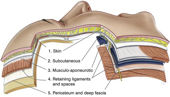 Dissection Range in Facelift Surgery image 1