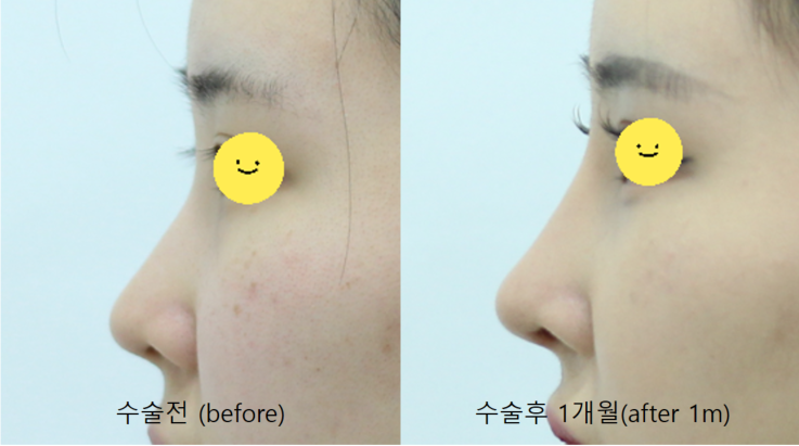 코성형에서 비중격 연골과 귀연골의 용도 관련 이미지 12