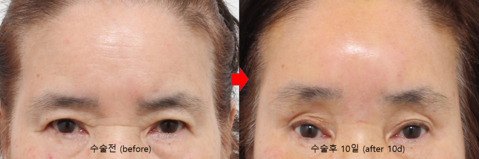 Surgical Methods That Reduce Nerve Symptoms in Endoscopic Brow Lift image 4
