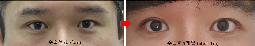 Types of Under-Eye Hollowness and Correction Methods image 9