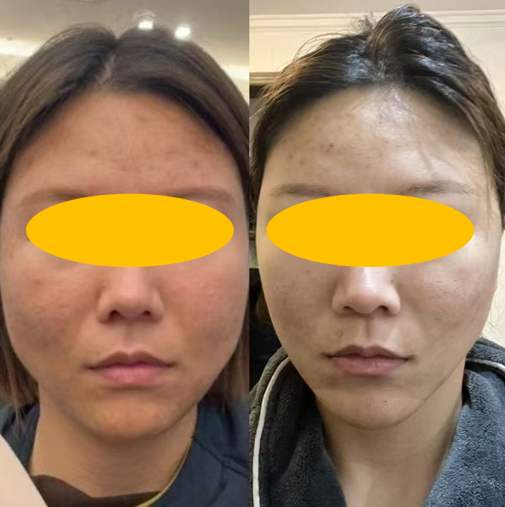 미니거상의 진화, MACS에서 딥미니거상(MADE)까지 관련 이미지 6