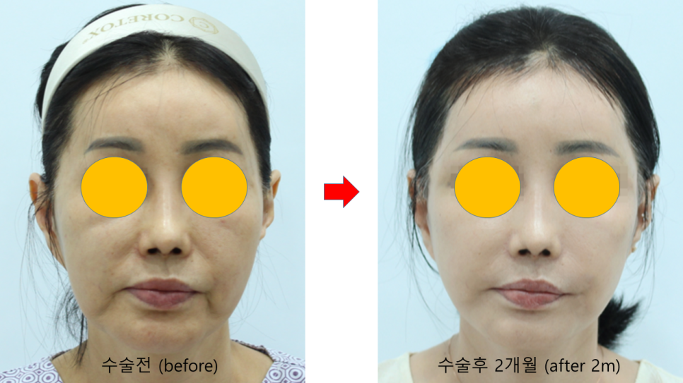 안면거상 재수술에서 수술 방법의 선택 관련 이미지 8