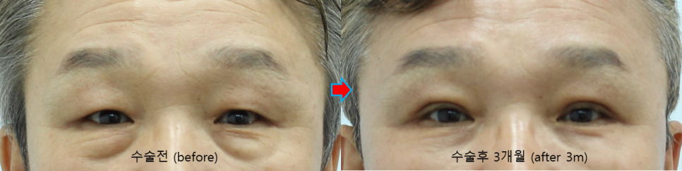 Recovery Process and Natural Impression Changes After Upper and Lower Eyelid Surgery in a Man in His 50s image 4