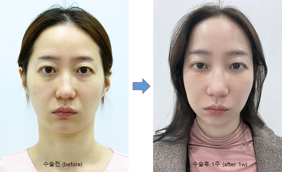 직장인들에게 가장 인기있는 성형 항목 관련 이미지 7