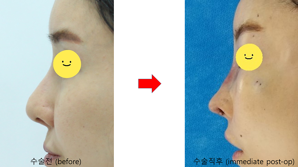 코끝떨어짐 늑연골 재수술 관련 이미지 8
