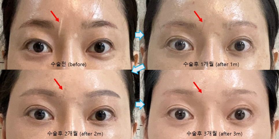 흉터성형과 흉터성숙, 시간이 지나면 흉터는 어떻게 변할까요? 관련 이미지 4