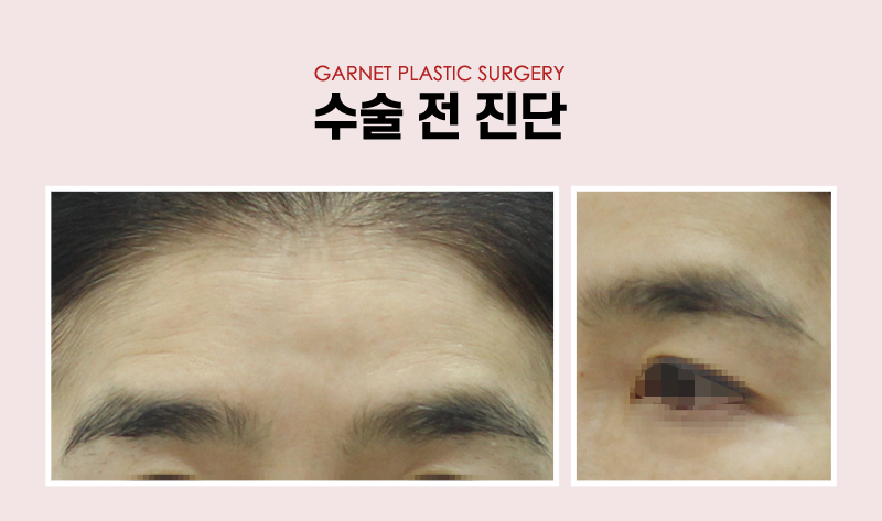 【가넷성형외과 백인수원장 성형칼럼】 50대 여성 이마거상 후 빠른 회복 관련 이미지 3