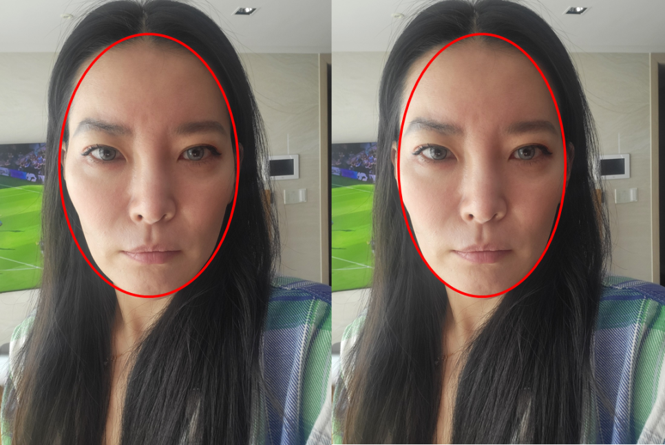 PRP Fat Grafting to Correct a Peanut-Shaped Face image 4