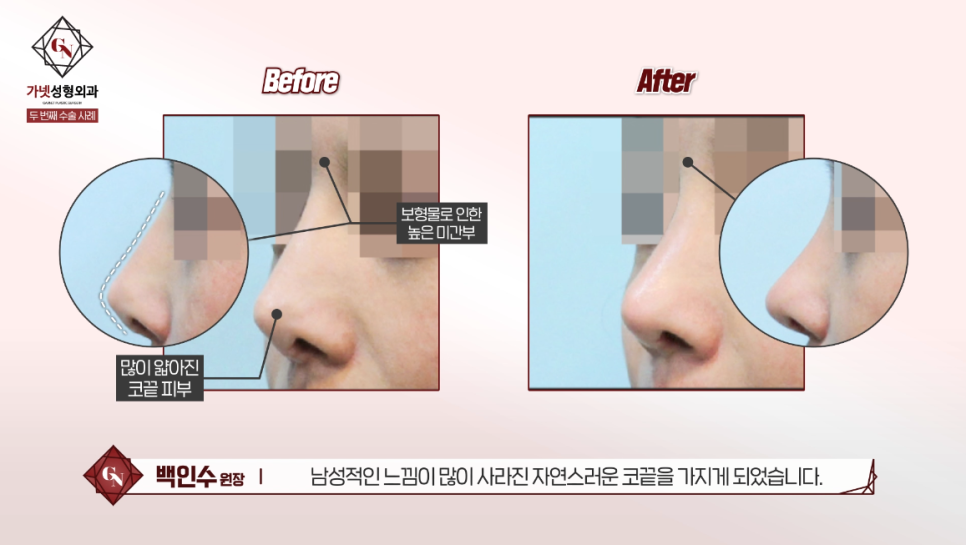 Why You Should Have Revision Rhinoplasty at a Place That Specializes in Apgujeong Nose Revision Surgery (ft. Dr. Baek In-soo) image 7
