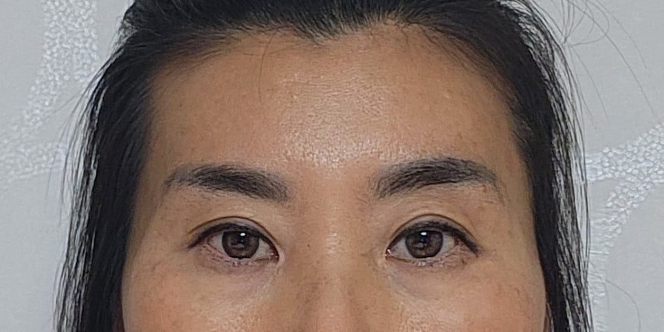 꺼진 관자와 납작한 이마, 지방이식으로 부드러운 인상 변화 관련 이미지 1
