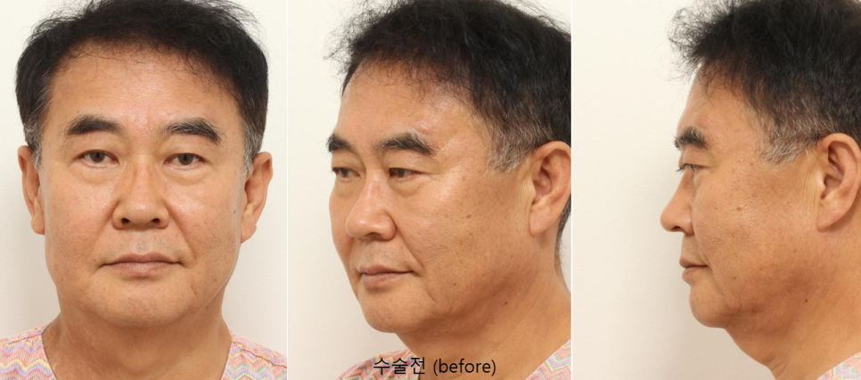 60대 남자 거상수술, 브래드 피트와 비슷한 나이의 실제 수술 사례 관련 이미지 2