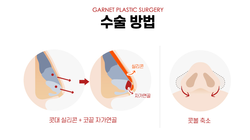 【가넷성형외과 백인수원장 성형칼럼】 코필러제거 후 코수술 케이스 관련 이미지 5