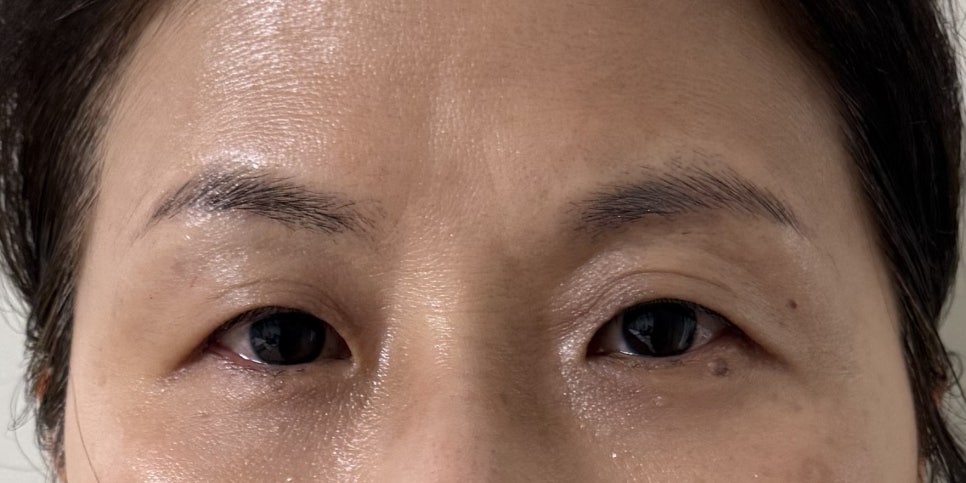 50대 쌍꺼풀 수술, 이마거상과 함께해야 자연스러운 이유 관련 이미지 2