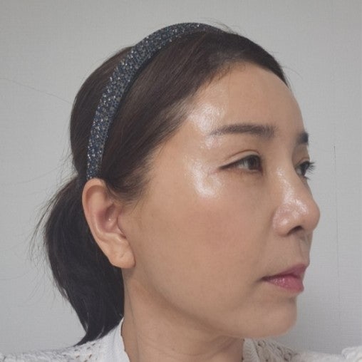 안면거상의 회복기간 관련 이미지 8