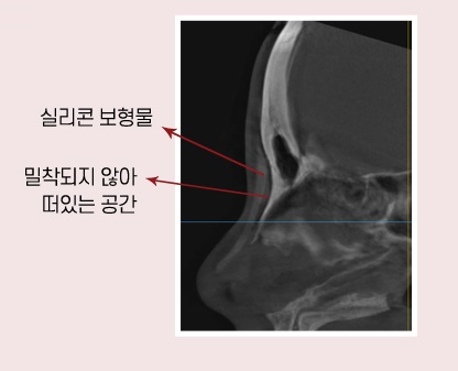 【Garnet Plastic Surgery Director Baek Insoo’s Plastic Surgery Column】 Rib Cartilage Contracted Nose Revision Surgery (Removal of Nose Implant) image 4