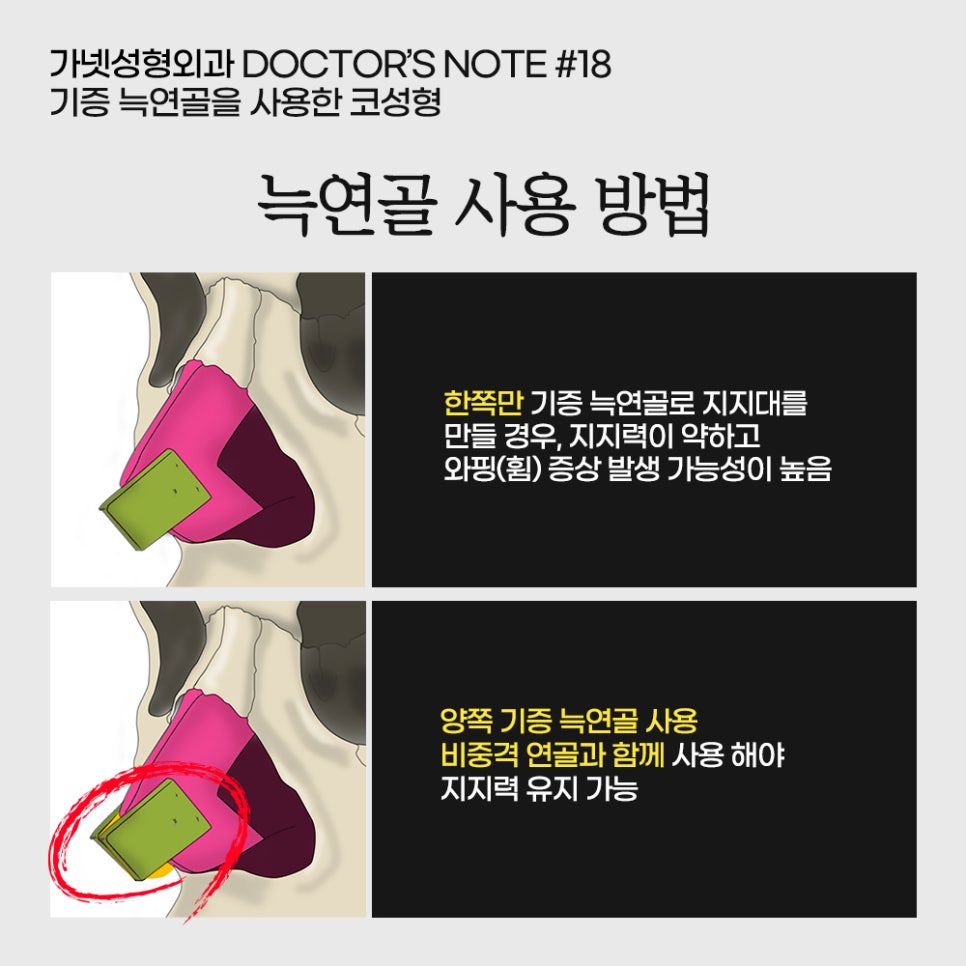 [Garnet Plastic Surgery Director Baek In-soo's Plastic Surgery Column] Rhinoplasty Using Donated Rib Cartilage image 7