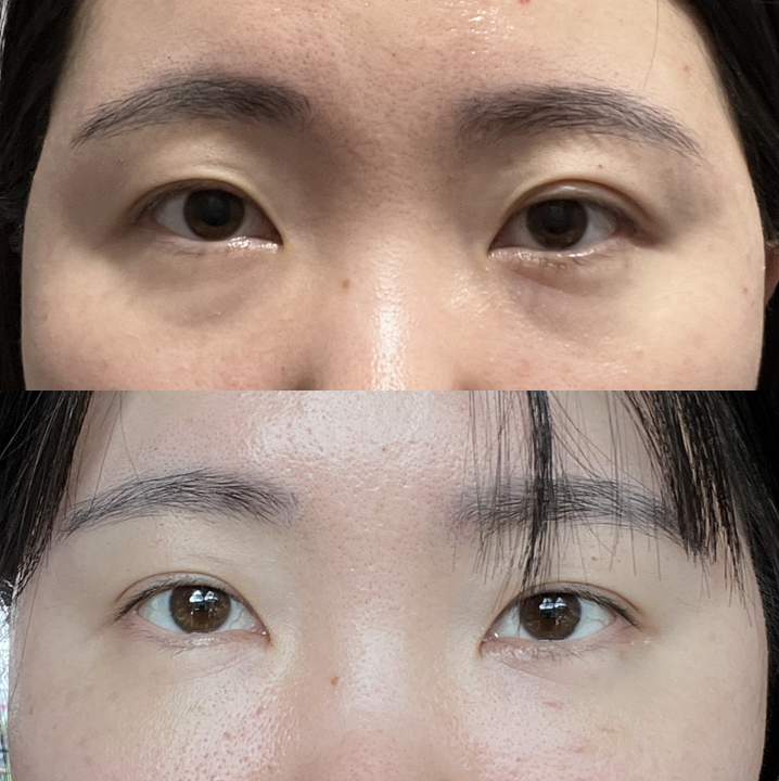 이영지 눈밑지방재배치, 시술일까 수술일까? 관련 이미지 8