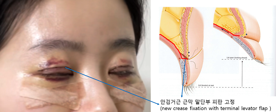 쌍꺼풀 함몰흉터를 교정하는 재수술 관련 이미지 3