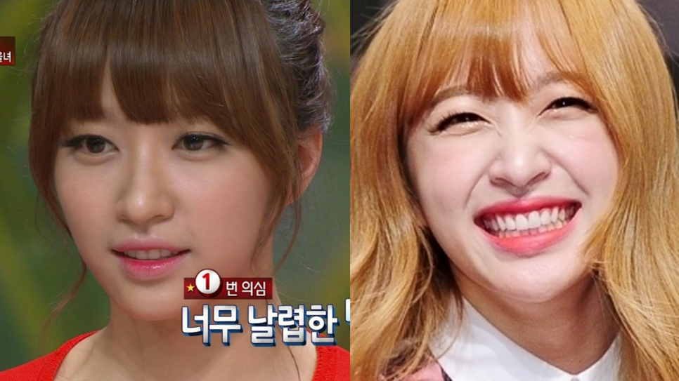 긴코 교정과 비순각 조절을 위한 코끝 리모델링 관련 이미지 2