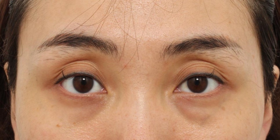 여름휴가 성형, 직장인에게 인기 있는 눈밑지방재배치(Hamra법) 관련 이미지 1