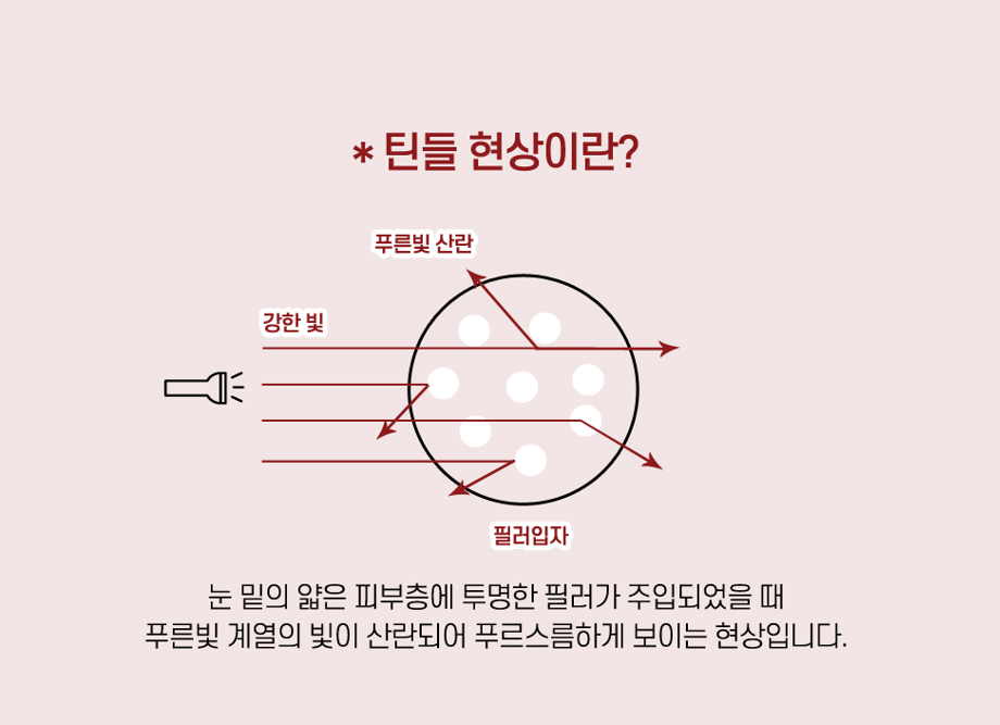 【가넷성형외과 백인수원장 성형칼럼】 애교필러 VS 눈밑 미세지방이식 관련 이미지 4