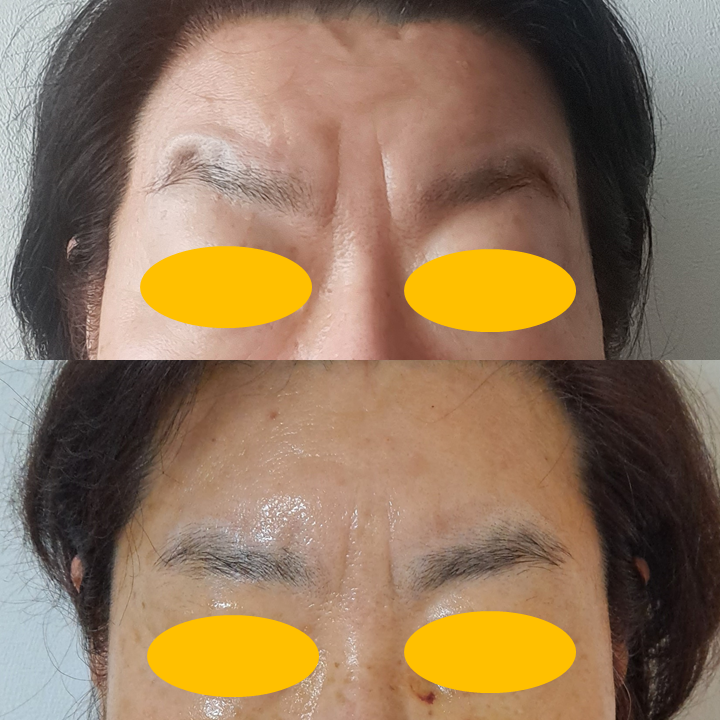이마거상으로 화난 눈썹을 교정할 수 있을까요? 관련 이미지 5