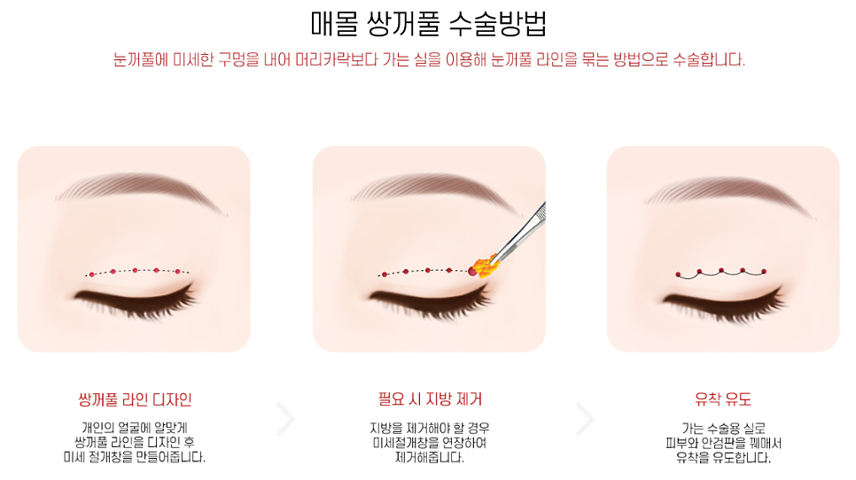 Non-incisional Eye Correction in Revision Surgery for Buried-Method Double Eyelids image 1