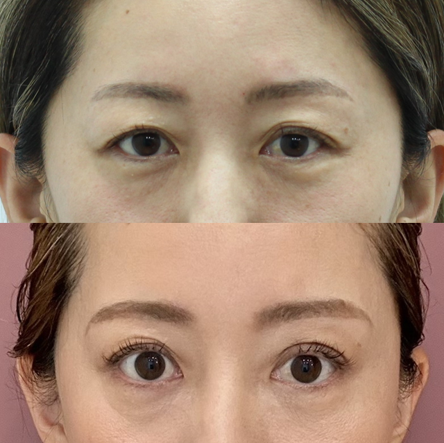Recovery Process After a Subbrow Lift (Under-Brow Lift) image 5