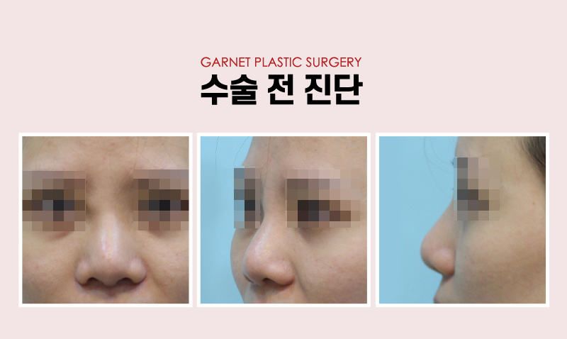 【가넷성형외과 백인수원장 성형칼럼】 코필러제거 후 코수술 케이스 관련 이미지 3