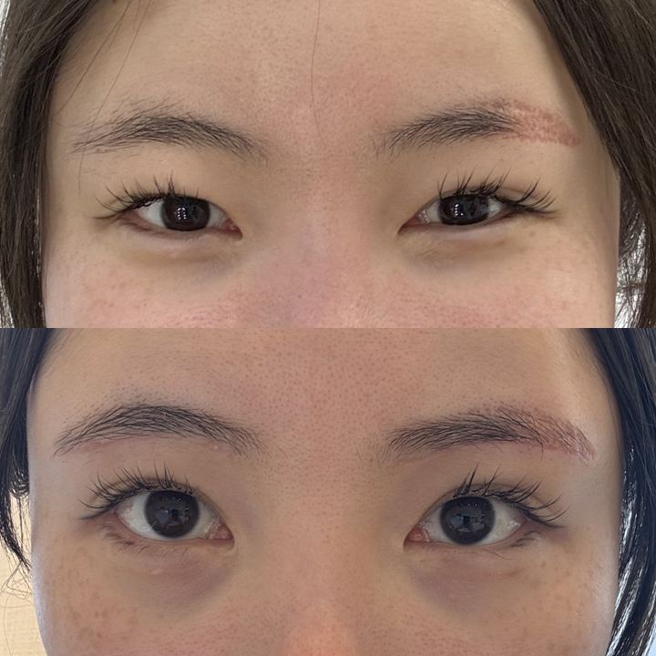 Resolving Eyebrow Semi-Permanent Dissatisfaction and Drooping Eyelids at the Same Time image 3
