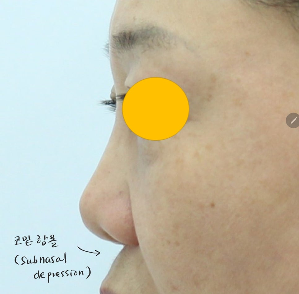 Use of Rib Cartilage in Midlife Rhinoplasty image 3
