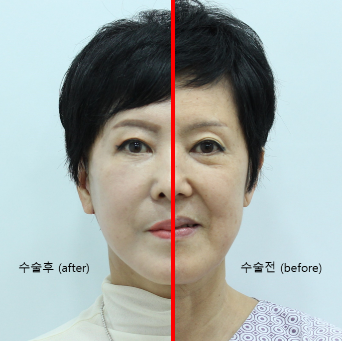 Deep Plane Facelift and Neck Lift image 4
