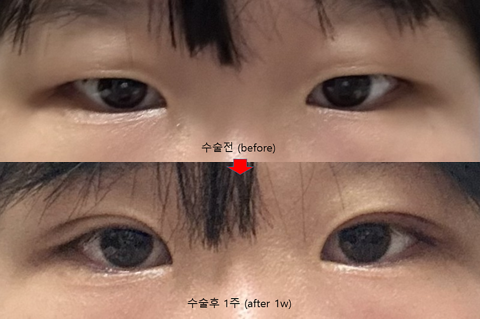 First-Eye Surgery with a Non-Incision Method (Buried Suture Double-Eyelid Surgery) image 3