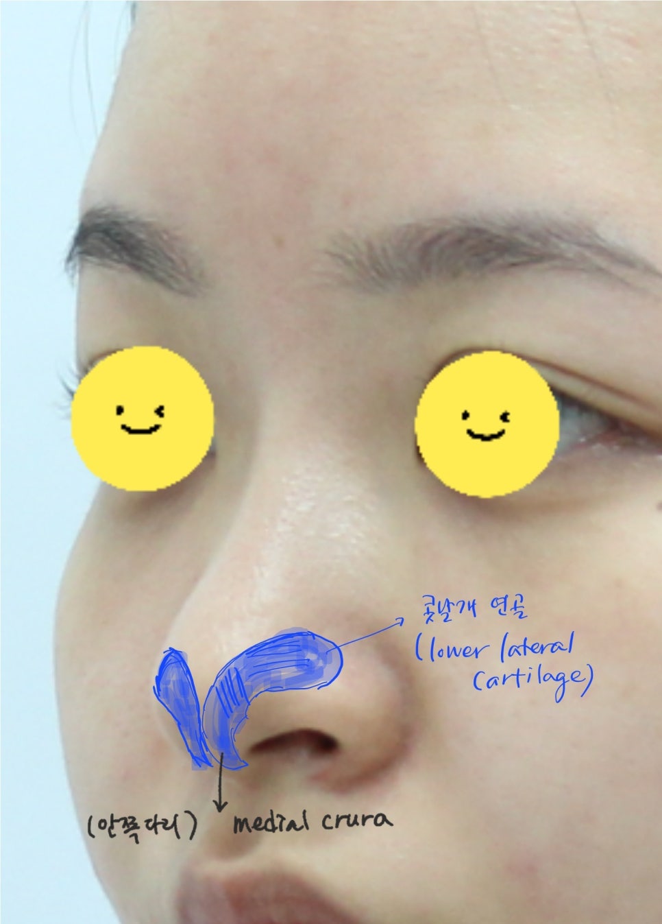 Nasal Tip Remodeling for Bulbous Nose and Drooping Columella Correction image 2