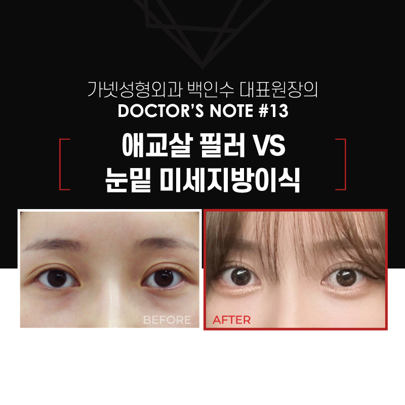 【가넷성형외과 백인수원장 성형칼럼】 애교필러 VS 눈밑 미세지방이식 관련 이미지 2