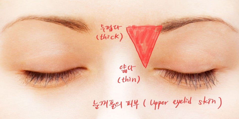 Forehead Lift After Upper Blepharoplasty image 3