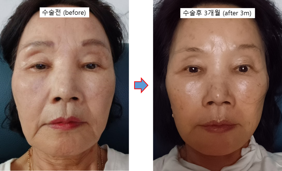 70대 안면거상 가능할까? 회복과정과 3개월 전후 실제 사례 관련 이미지 5
